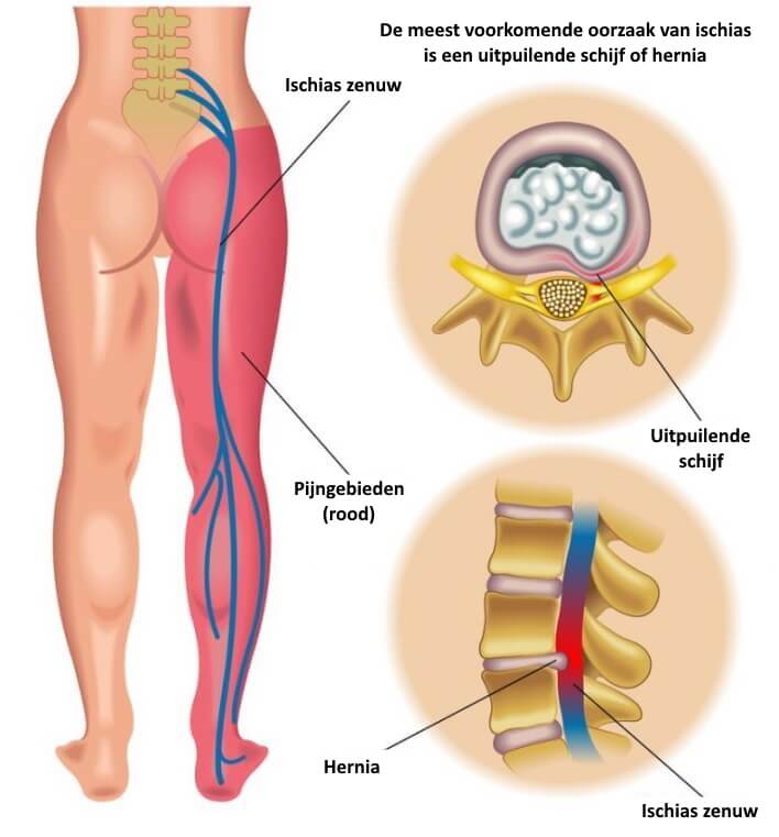 ischias pijn