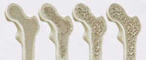osteoperose