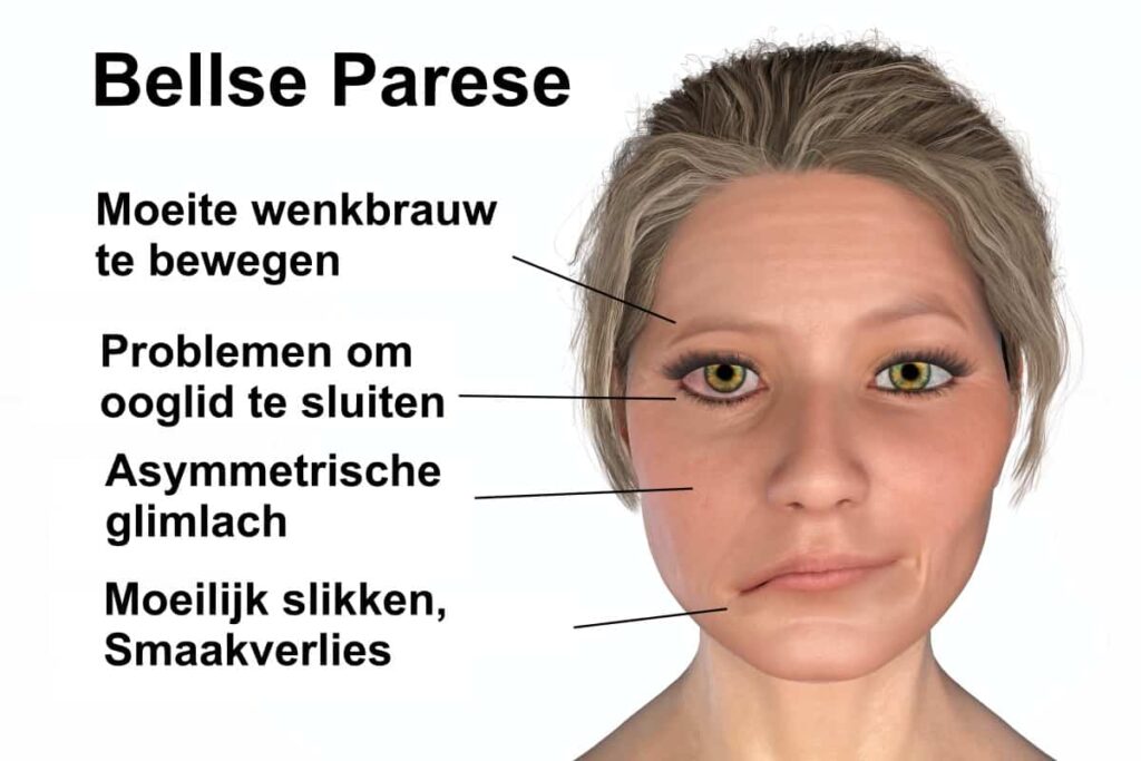 bellse parese klachten