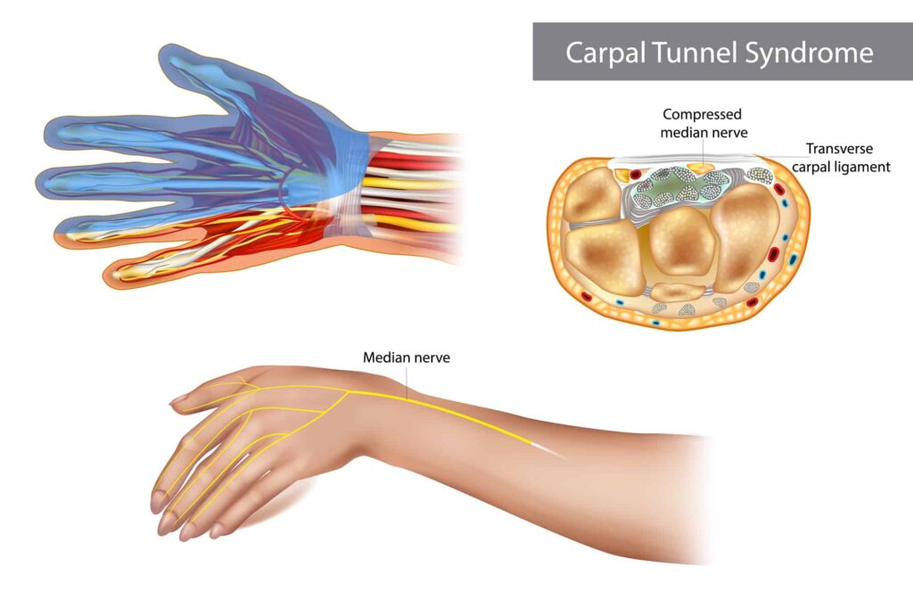 carpaal tunnel syndroom