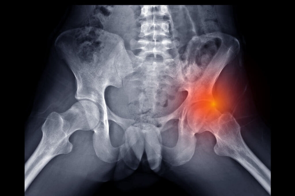 Heup impingement